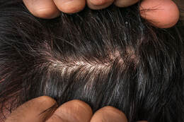 Picture of Dry Scalp
